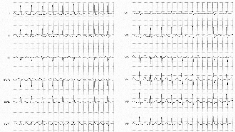 Atrial Flutter